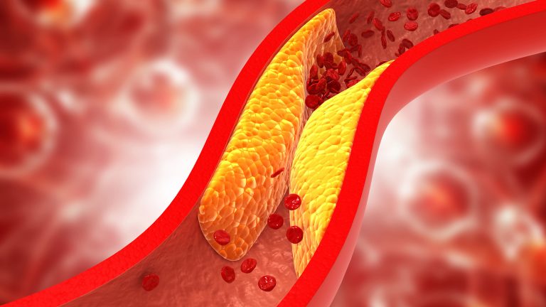 Everything You Need to Know About High Cholesterol High Cholesterol
